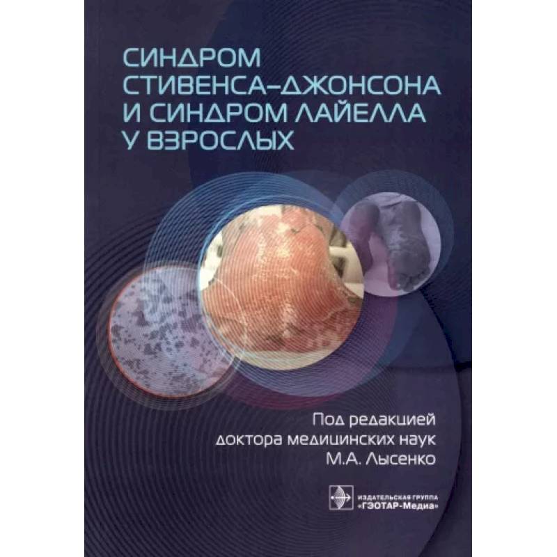 Синдром Стивенса-Джонсона и синдром Лайелла у взрослых Синдром Стивенса-Джонсона и синдром Лайелла у взрослых