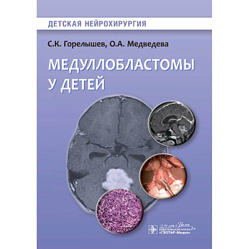 Медуллобластомы у детей Медуллобластомы у детей